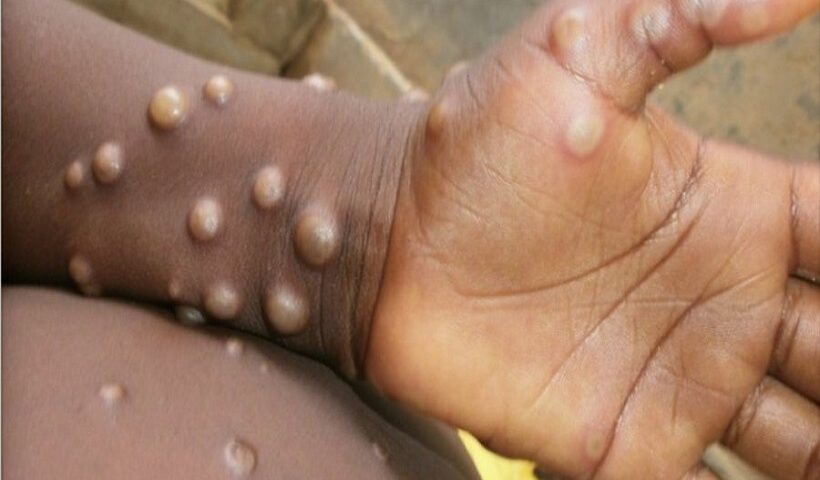 मंकीपॉक्स