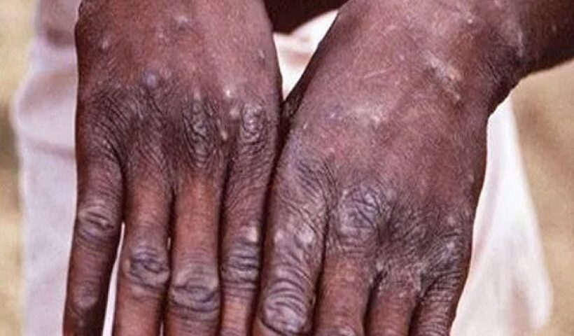 Monkeypox