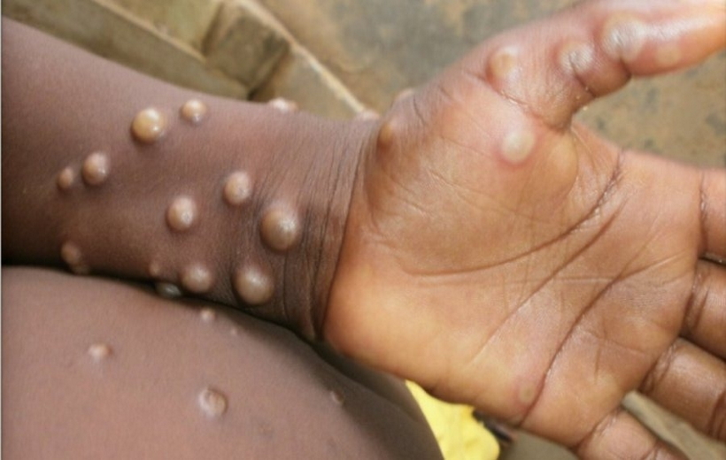Monkeypox