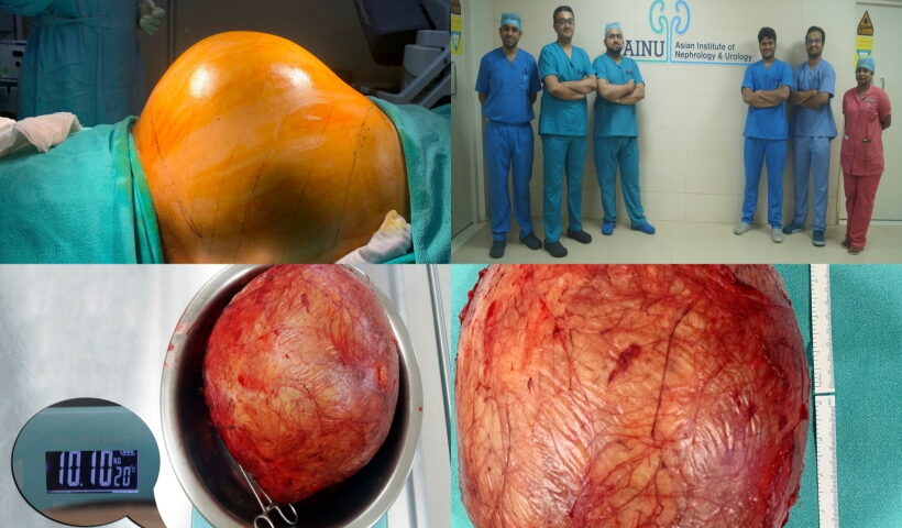 doctors at Hyderabad hospital remove football-sized kidney tumour.