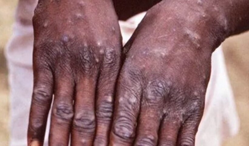 monkeypox