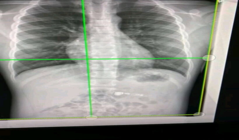 Christmas gift landed a 7-year-old boy in the US state of Georgia to the hospital last week after he accidentally swallowed an Apple AirPod he had received as a gift just days earlier.