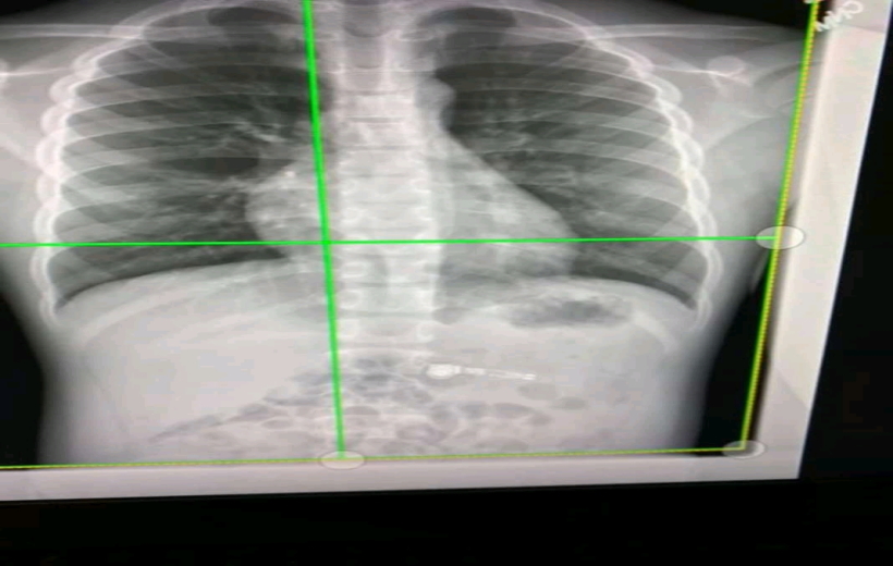 Christmas gift landed a 7-year-old boy in the US state of Georgia to the hospital last week after he accidentally swallowed an Apple AirPod he had received as a gift just days earlier.