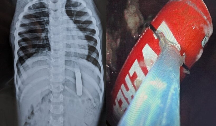 Kerala doctors saves 2 year old kid who swallowed battery.