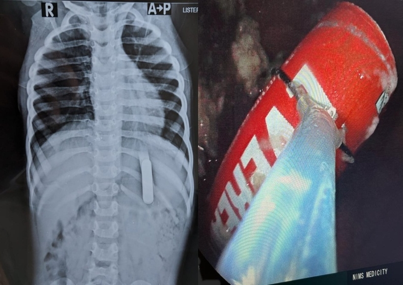 Kerala doctors saves 2 year old kid who swallowed battery.