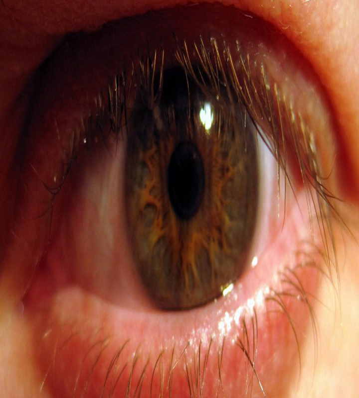 दिल्ली में आई फ्लू और डेंगू के मामलों में रिकॉर्ड वृद्धि