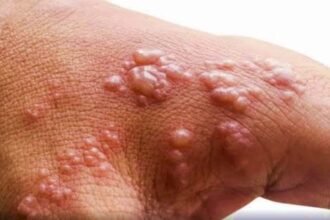 Monkeypox infection