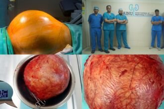 AINU Hyderabad doctors remove football-sized kidney tumour from a 53 years old patient