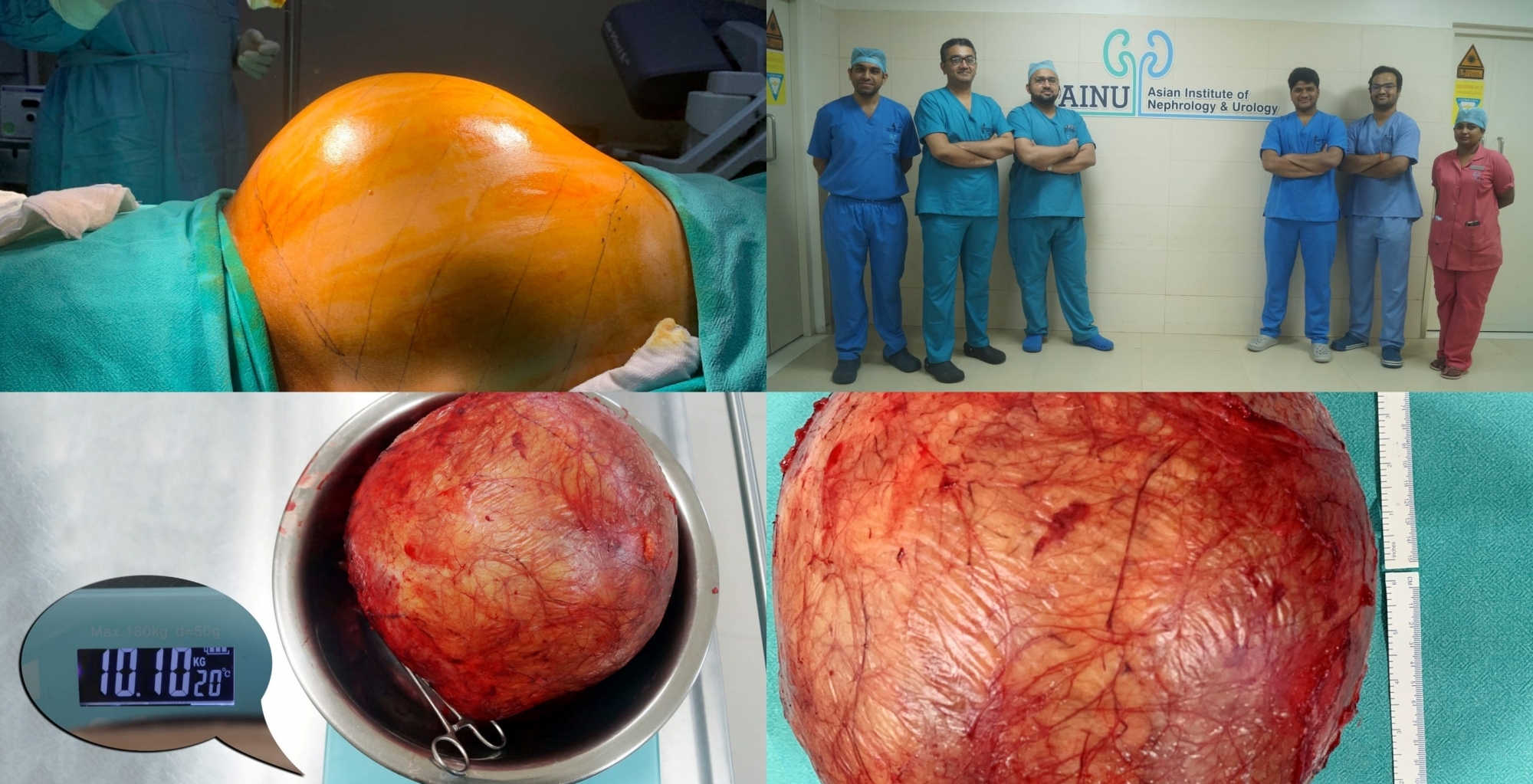 AINU Hyderabad doctors remove football-sized kidney tumour from a 53 years old patient