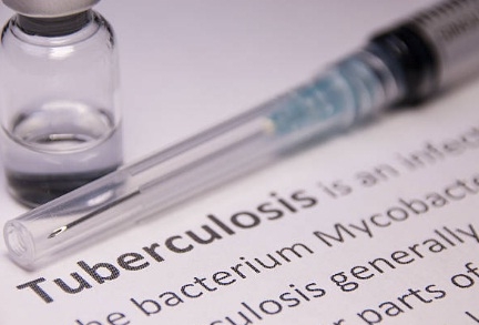 Tuberculosis