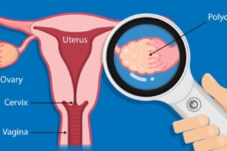 PCOS May Double Risk Of Ovarian Cancer After Menopause: Study
