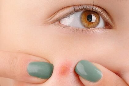 Pimples popping myths